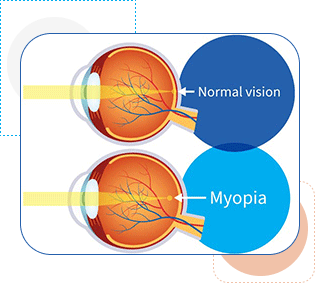 Understanding Myopia