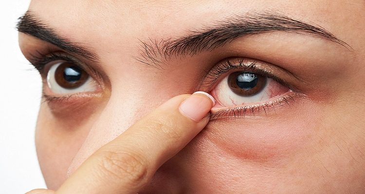 Dry Eye: A Comprehensive Guide to Signs and Symptoms